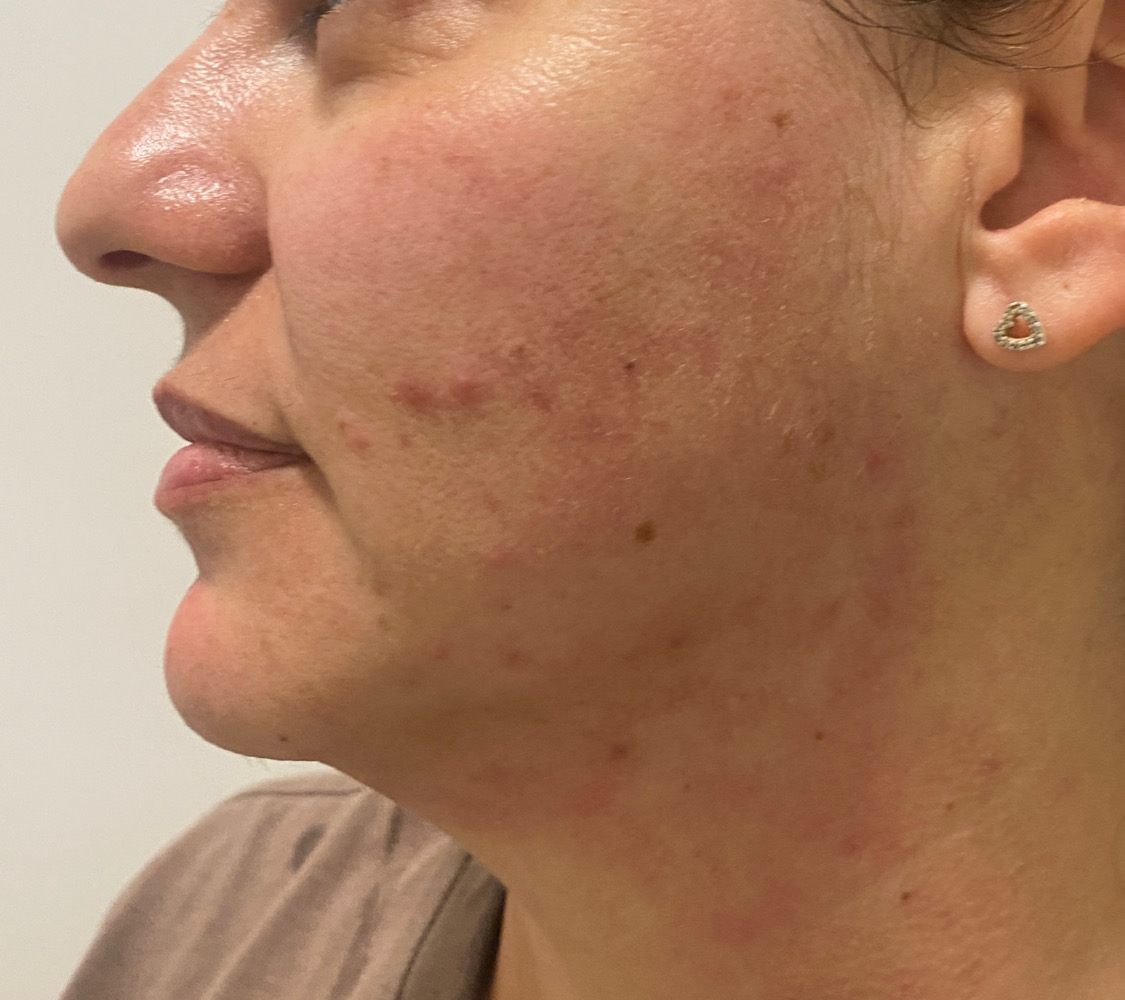 Client's cheek and jawline in profile after RF skin tightening, skin smoother and brighter