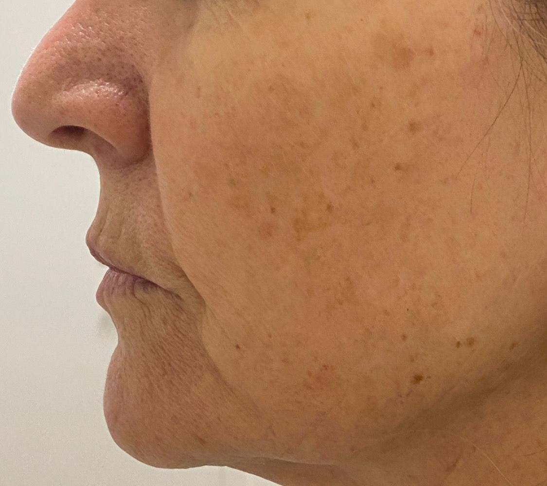 Client's lower face and jawline before RF skin tightening