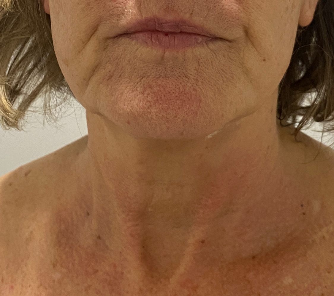 Client's jaw and neck after a single RF skin tightening session