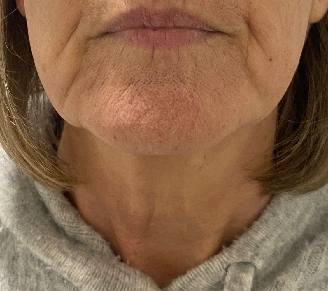Client's jaw and neck before RF skin tightening