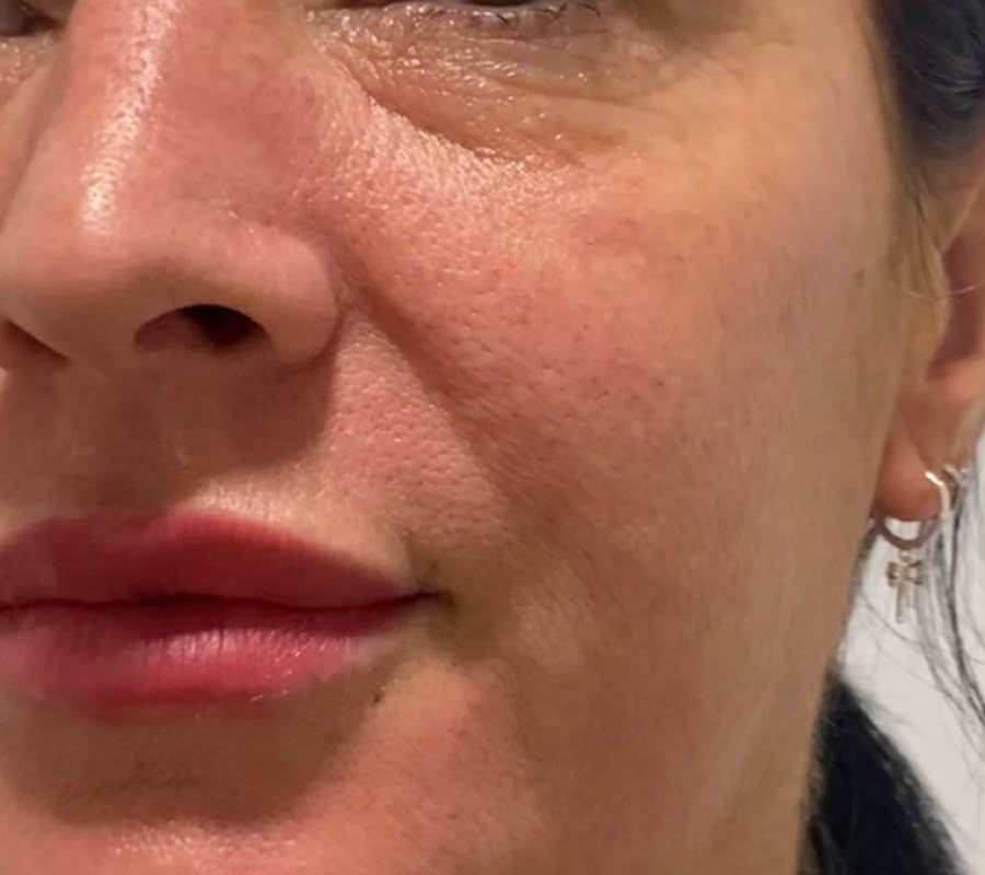 Client's cheek and smile lines after a single RF skin tightening session, skin smoother and firmer