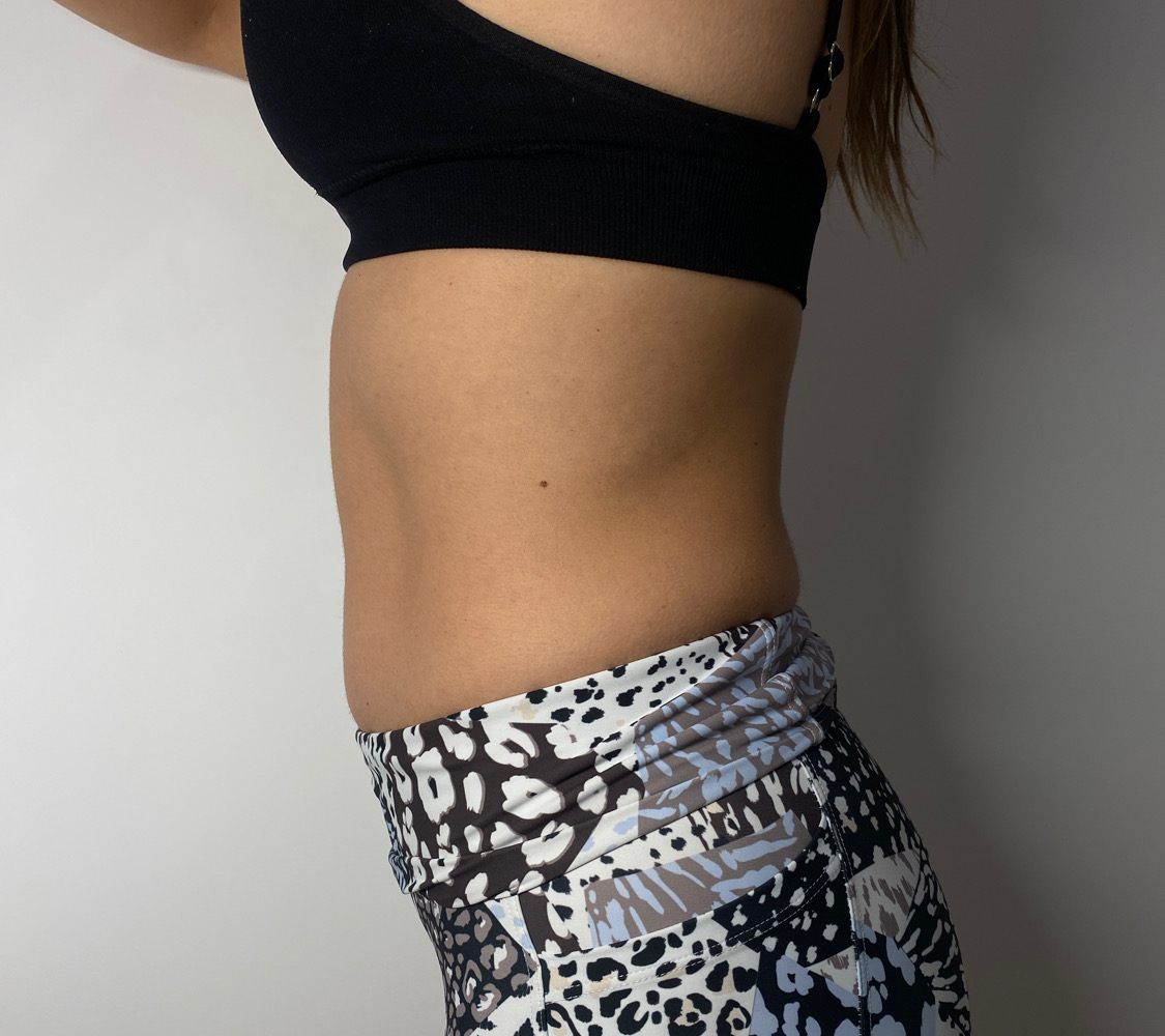 Client's lower tummy after one body contouring session, visibly flatter
