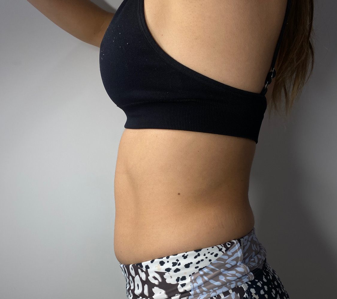 Client's lower tummy before body contouring